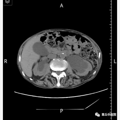 查肾功能发现血肌酐高达498 umol/l, ct提示双肾积水,膀胱结石,前列腺