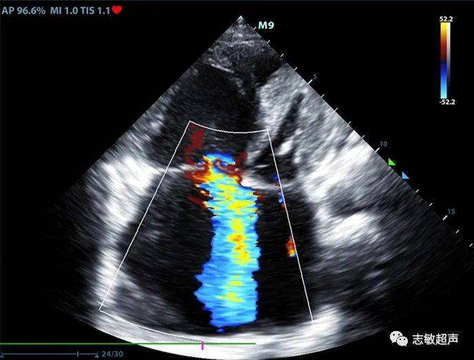 典型病例--法洛三联症_诊断_右室_超声