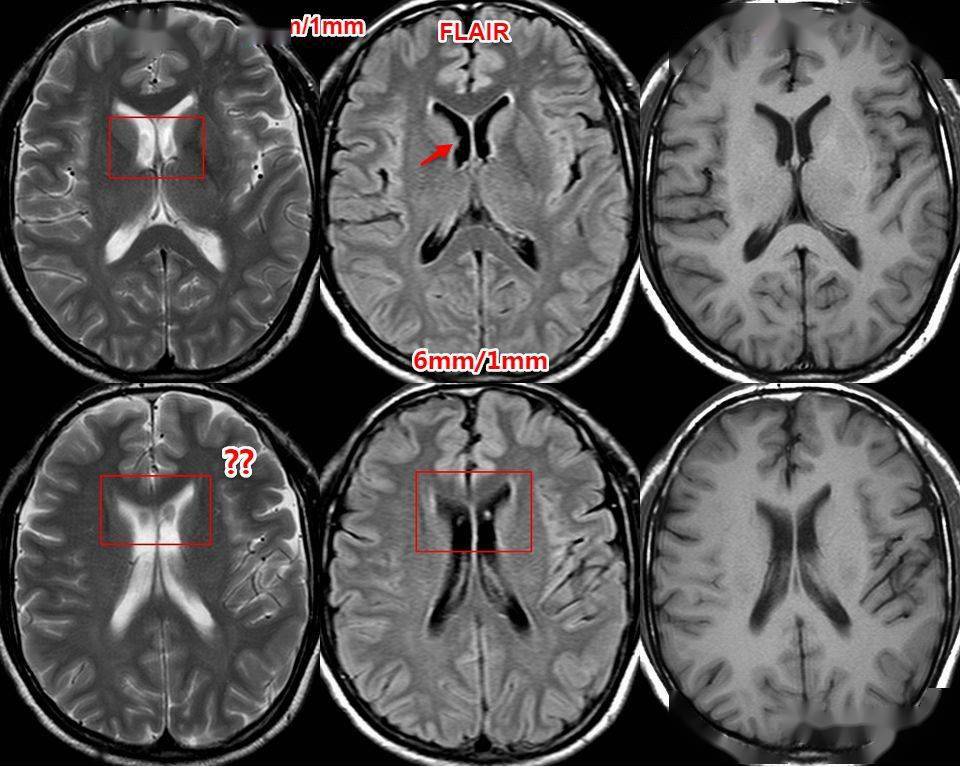 太精华了头颅mri入门之易误诊影像系列