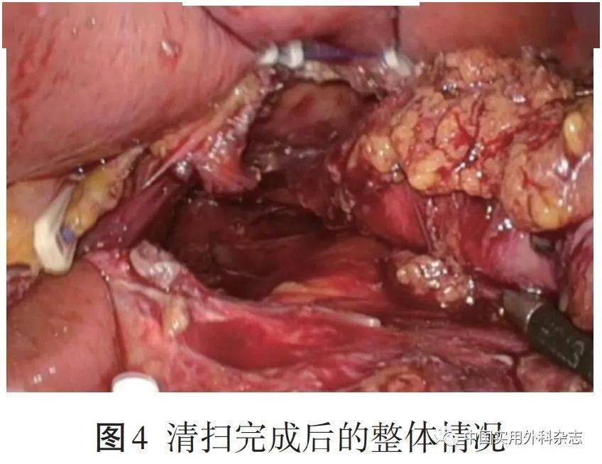 Ⅱ型食管胃结合部腺癌根治术中应用价值研究_手术_病人_siewert