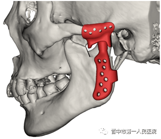颞下颌关节磁共振显示:左侧关节盘不可复性前移位,关节盘变形,髁突