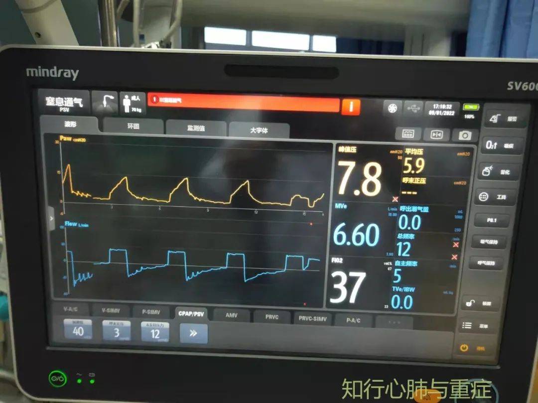 第82期呼吸机报警的种类原因及其处理策略