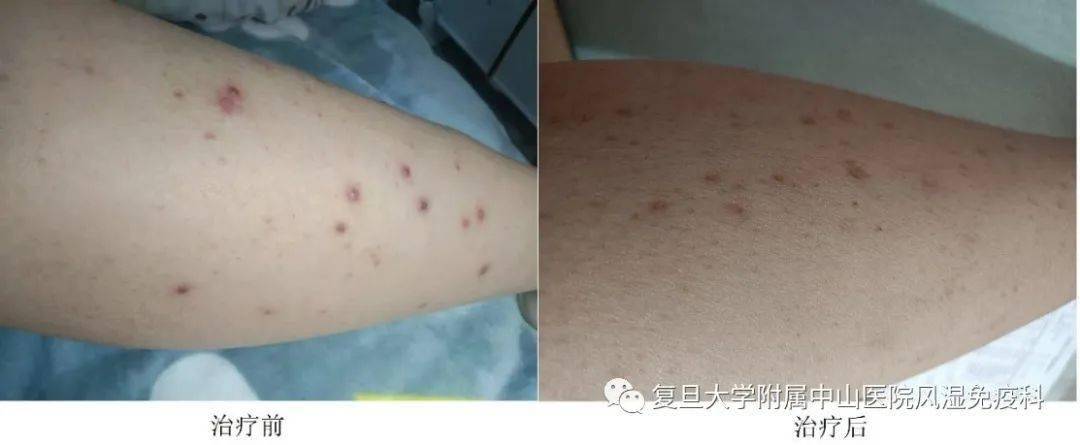 破译"白塞"表象下的基因密码_mg_cells_淋巴细胞