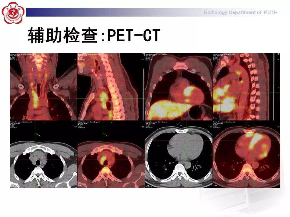 结节病的影像表现