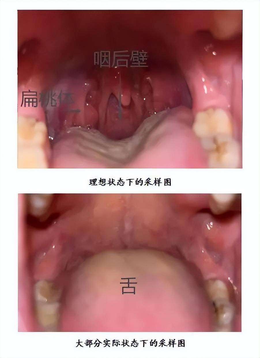 天天捅喉咙,但你可能不知道如何正确配合采核酸_采样_大白_口罩