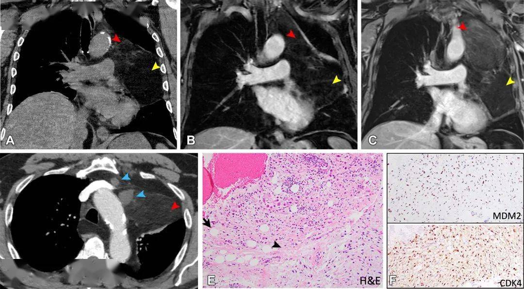 罕见原发性纵隔脂肪肉瘤6例影像及临床表现_肿块_显示_箭头