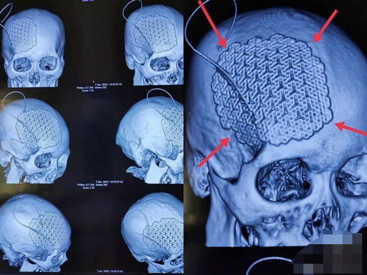 术前为患者进行头颅ct检查,采用三维数字化颅骨塑形技术根据患者颅骨