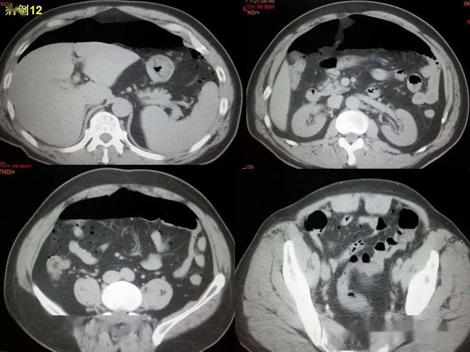 消化道穿孔ct影像大汇总看完印象深刻