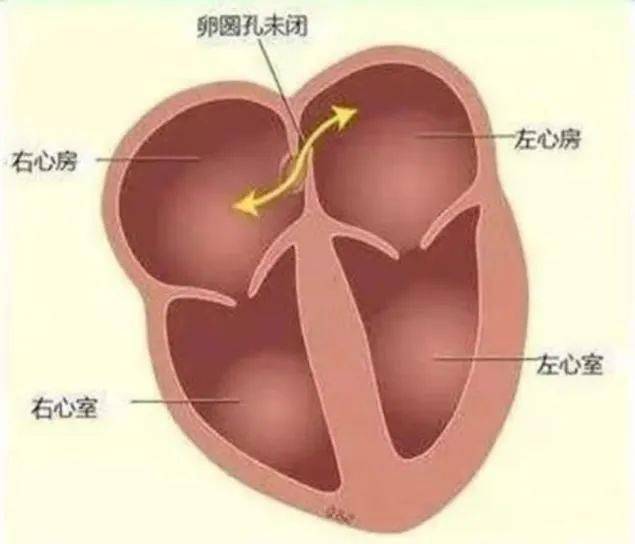 科普超声诊断宝宝的卵圆孔未闭家长需要担心吗