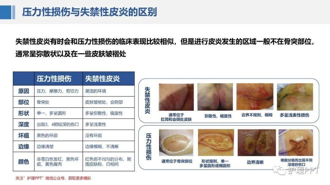 【ppt】失禁性皮炎的护理_急救_国际_雅思