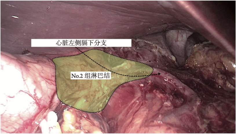 《腹腔镜胃肠手术笔记(第二版)》新书抢先看_网膜_淋巴结_结肠