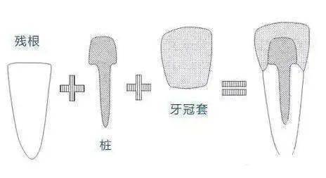 根管不做冠早晚是后患患者不做冠后牙齿劈成了两半