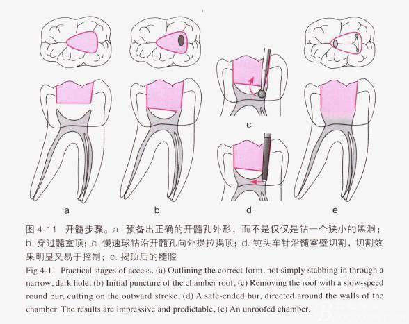 标准开髓口形态