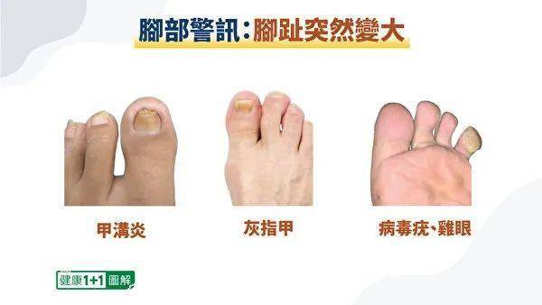 脚趾甲也可能因为感染霉菌而变粗变厚,形成灰指甲,看起来脚趾也比较大