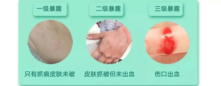 当然这视不同受伤情况，伤口暴露状态而定。暴露情况总共分为三种级别：一级暴露：最普通，接触的皮肤完整无