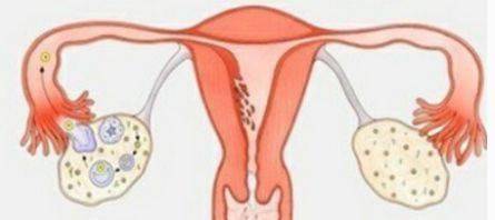 多囊卵巢综合症对日常生活的六大影响？(图1)