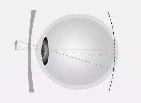 眼科医生的近视防控"神器 离焦眼镜【最全最新离焦镜片科普】_视