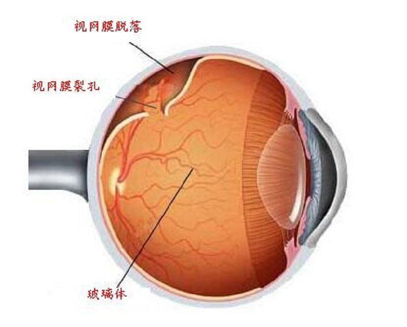 22岁考研女生用眼过度导致视网膜撕裂？