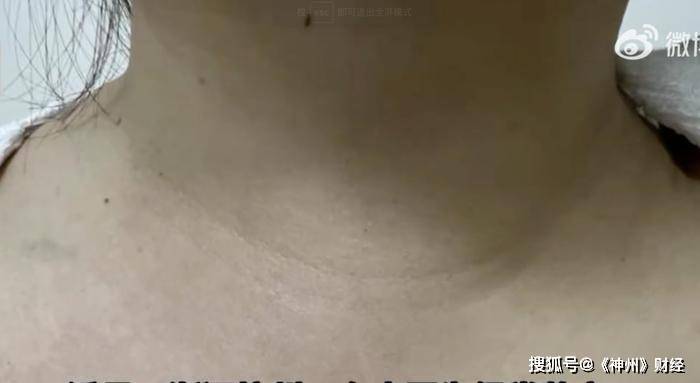 女子经常熬夜脖子变粗，一查患上癌症！经常熬夜当心这些后果