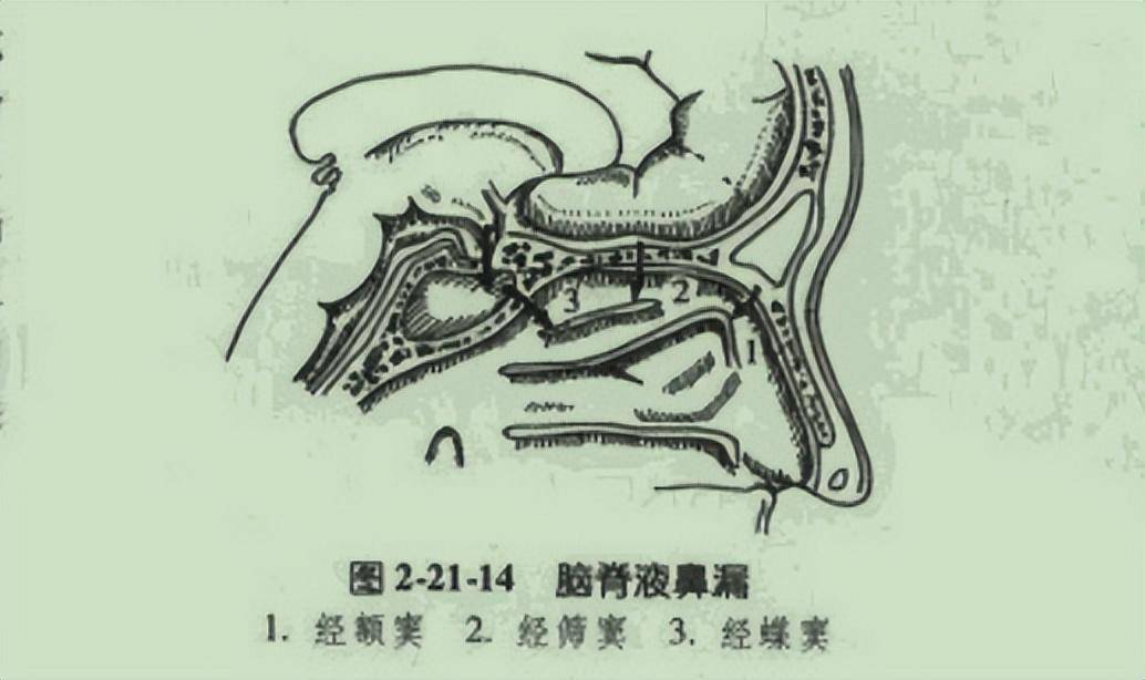 “流鼻涕”要小心！警惕脑脊液鼻漏的可能