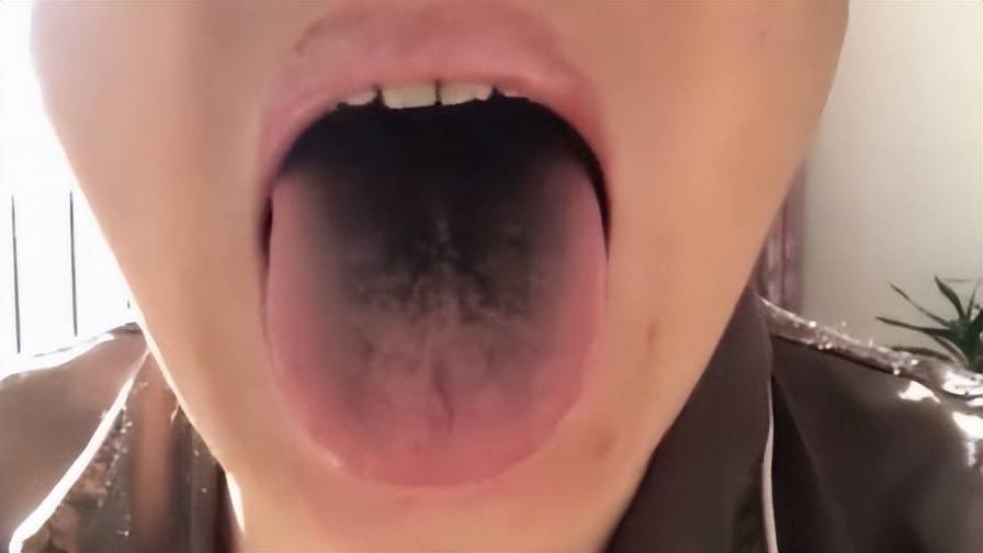 男子确诊后舌头牙齿全变黑，中医认为舌苔发黑是热极化火所致