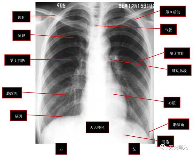 正常肺部ct片图片图解图片