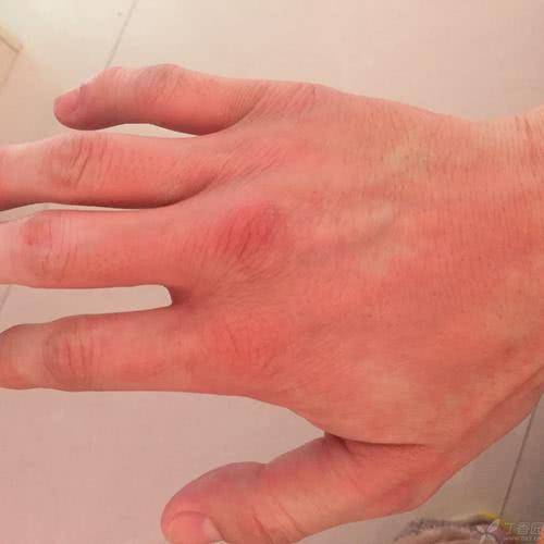 荨麻疹俗称为风疹块,主要是因为皮肤,黏膜小血管出现扩张,皮肤渗透性