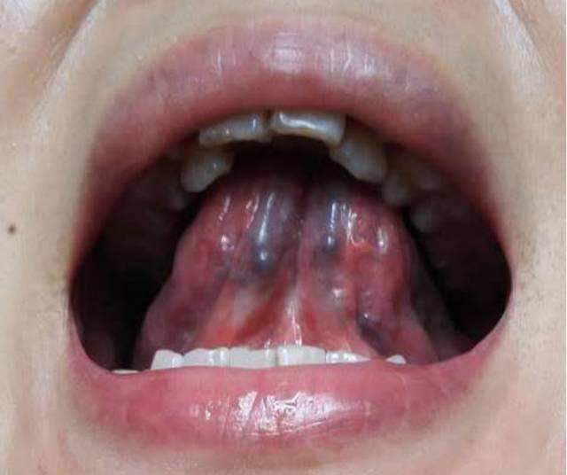 舌头下面红血丝明显图片