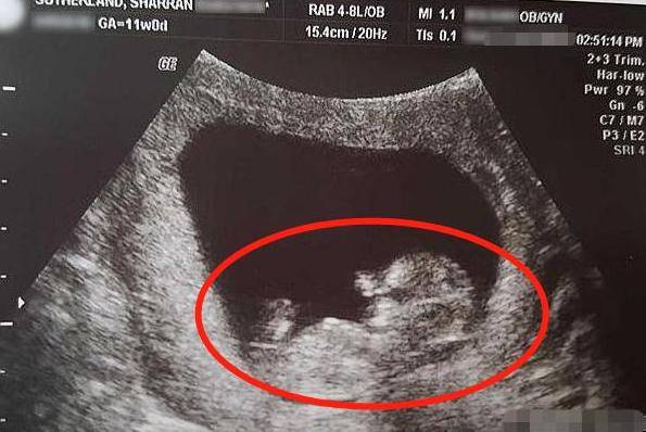 怀孕14周胎儿图片图片