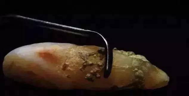 龈下结石,"隐形的"牙齿杀手!