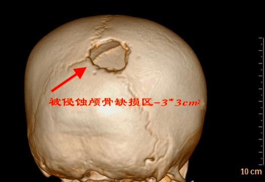 儿童颅骨骨瘤图片图片