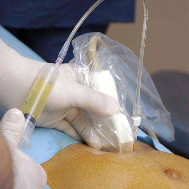 准妈妈做"羊水穿刺"现场,老公默默的喊加油,而妈妈已哭成泪人