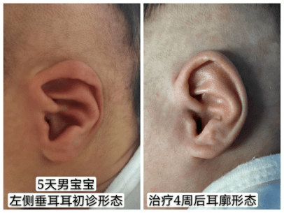新生儿耳朵畸形种类图片