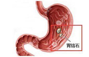 肾结石,胃结石,胆结石…身体里哪来这么多"石头"?