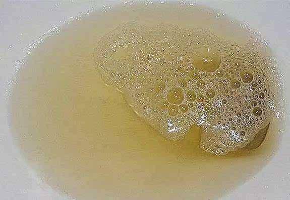 小便时有泡沫尿,是肾脏出问题了吗?正常泡沫尿多久消失呢?_手机搜狐网