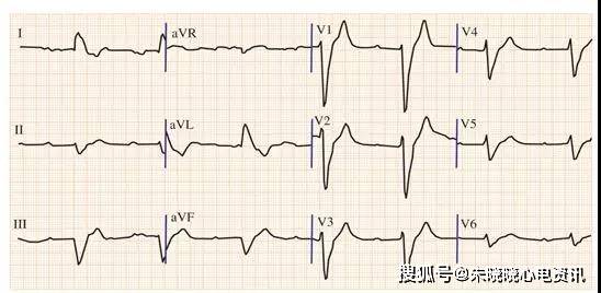 血鉀異常的心電圖表現,最經典的在這裡!