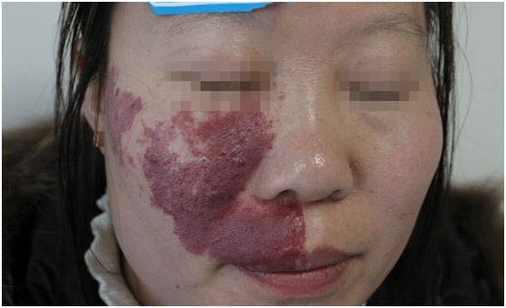 郑州市第二中医院科普:鲜红斑痣危害有哪些?