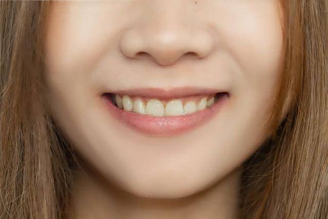 拯救大黄牙!禾憩独家"晶氧亮齿项目",只要1.5h让你重拾自信