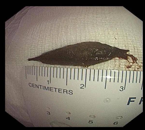 百岁老人吃粽子误吞枣核,东方医院医生2分钟完成取出手术!