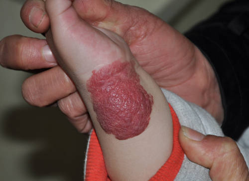 表浅的会有上皮萎缩,毛细血管扩张和疤痕;皮下血管瘤的会留有纤维脂肪