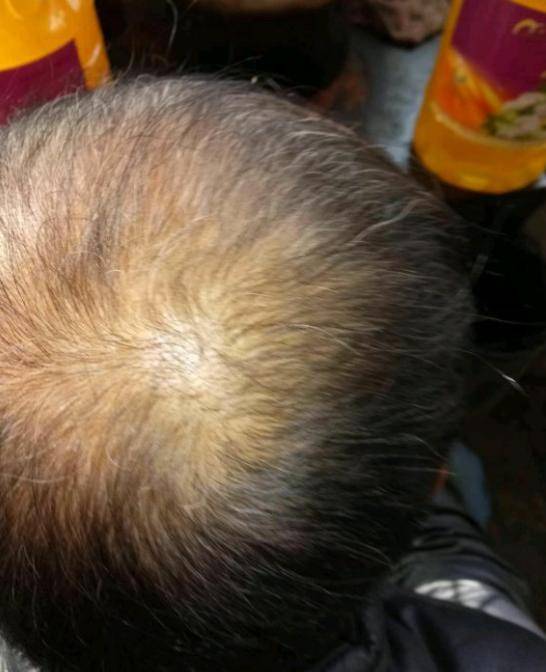 21岁小伙遗传性脱发4年,现在已经秃顶,90后活成了70后的样子