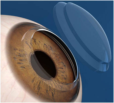 研究人员开发了一种很有前途的治疗方法来预防失明_角膜