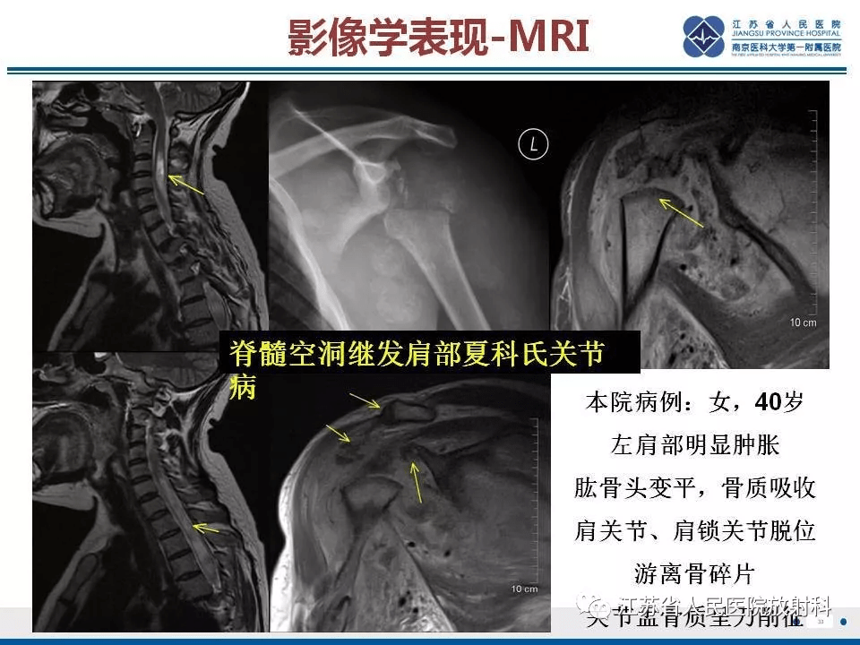 骨肌精读:夏科氏关节病例详解