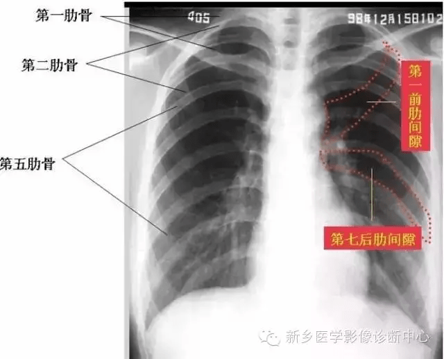 数肋骨是看x线胸片的基础,很多临床诊疗都是以肋骨作为标志的.