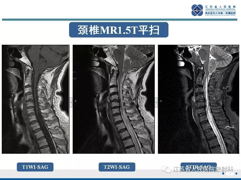 肘夏科氏关节病