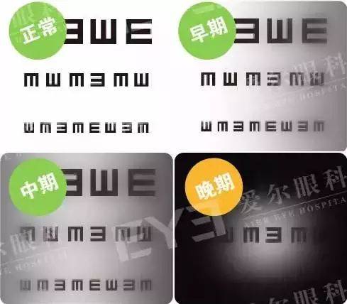 致盲|警惕这个“小偷”，一不小心它会偷走你的视力