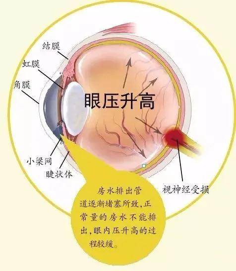 致盲|警惕这个“小偷”，一不小心它会偷走你的视力
