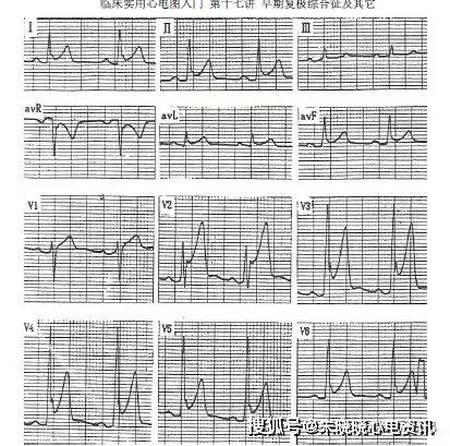 心电图早期复极图片
