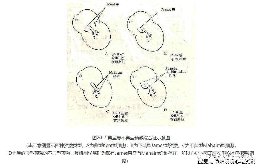 第二十讲:预激综合征(一)_传导