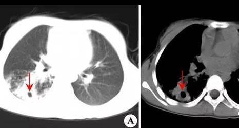 先天性支气管囊肿,支扩,肺脓肿的影像学鉴别